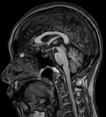 脳MRI