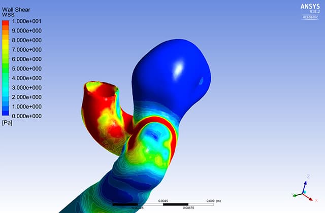動脈瘤壁のストレス解析